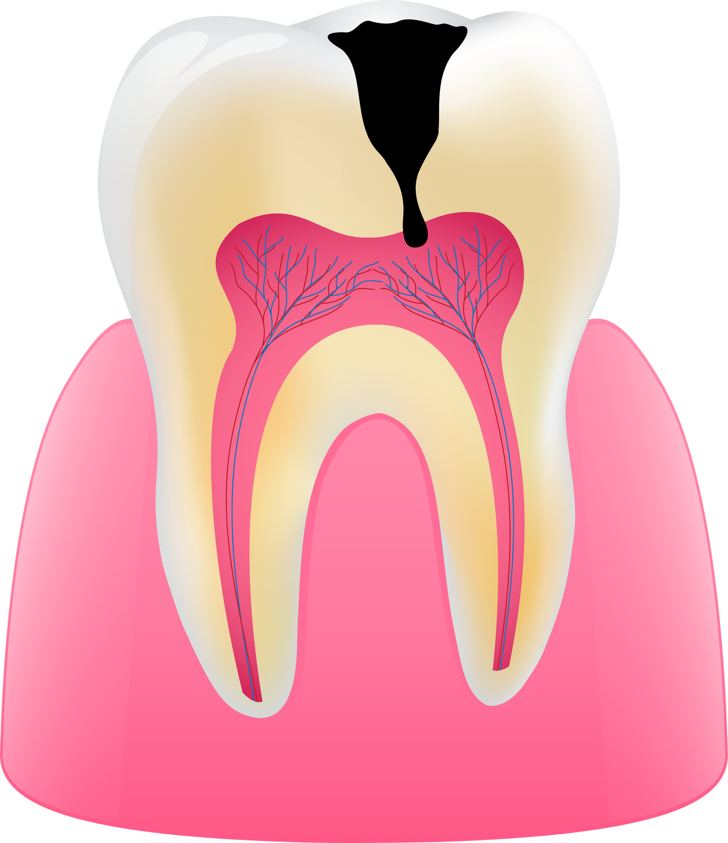 tooth caries