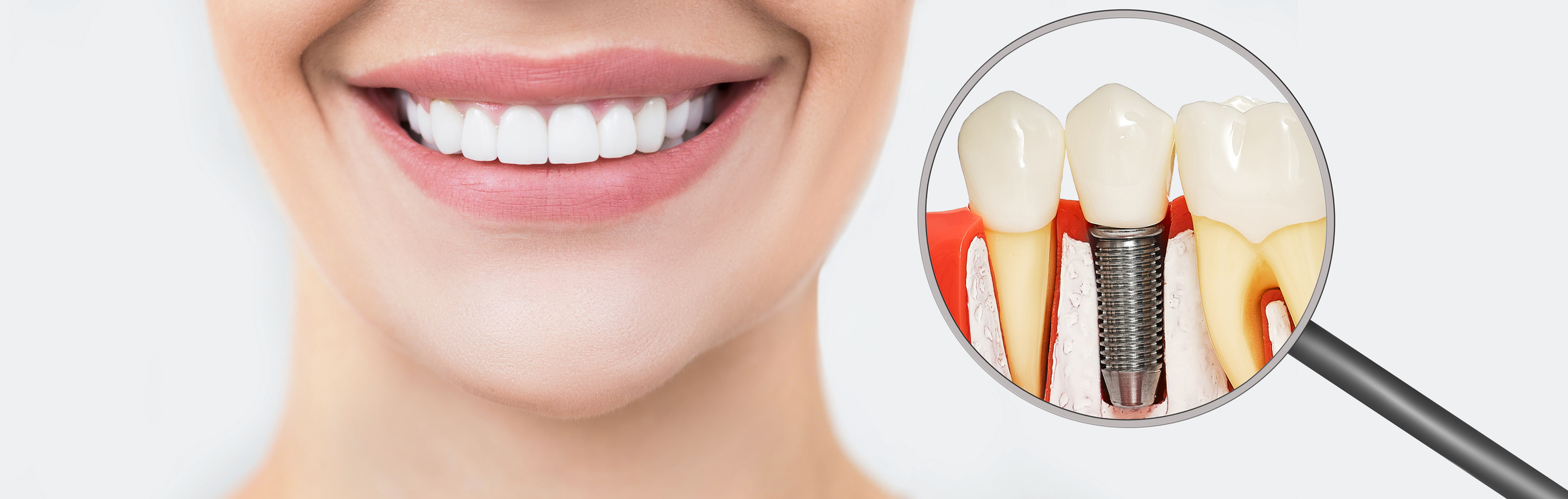 Perfect female smile, teeth after dental prosthetics by a dentist. Near magnified view of a dental implant installation