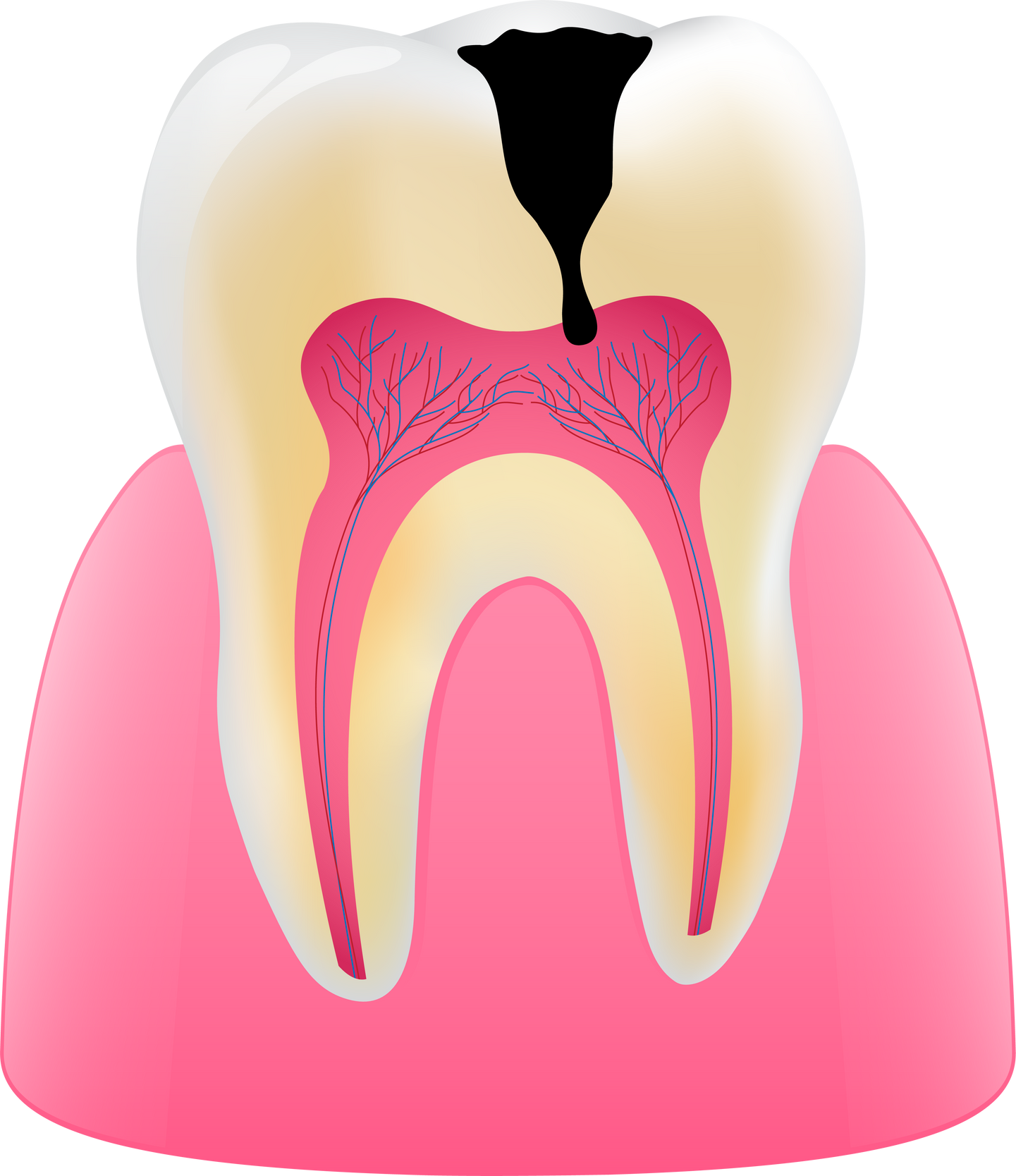 tooth caries