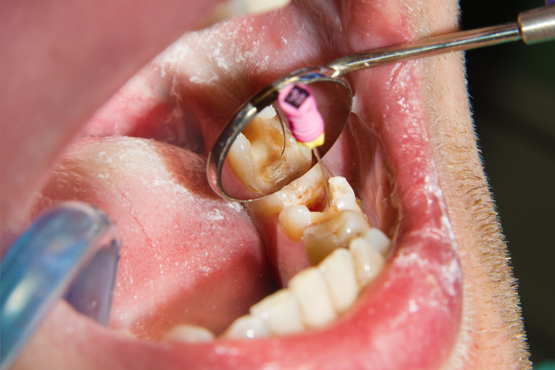 endodontic treatment of teeth close-up. Cleaning of the roots of the teeth and their filling. The concept of modern technology in the dental clinic