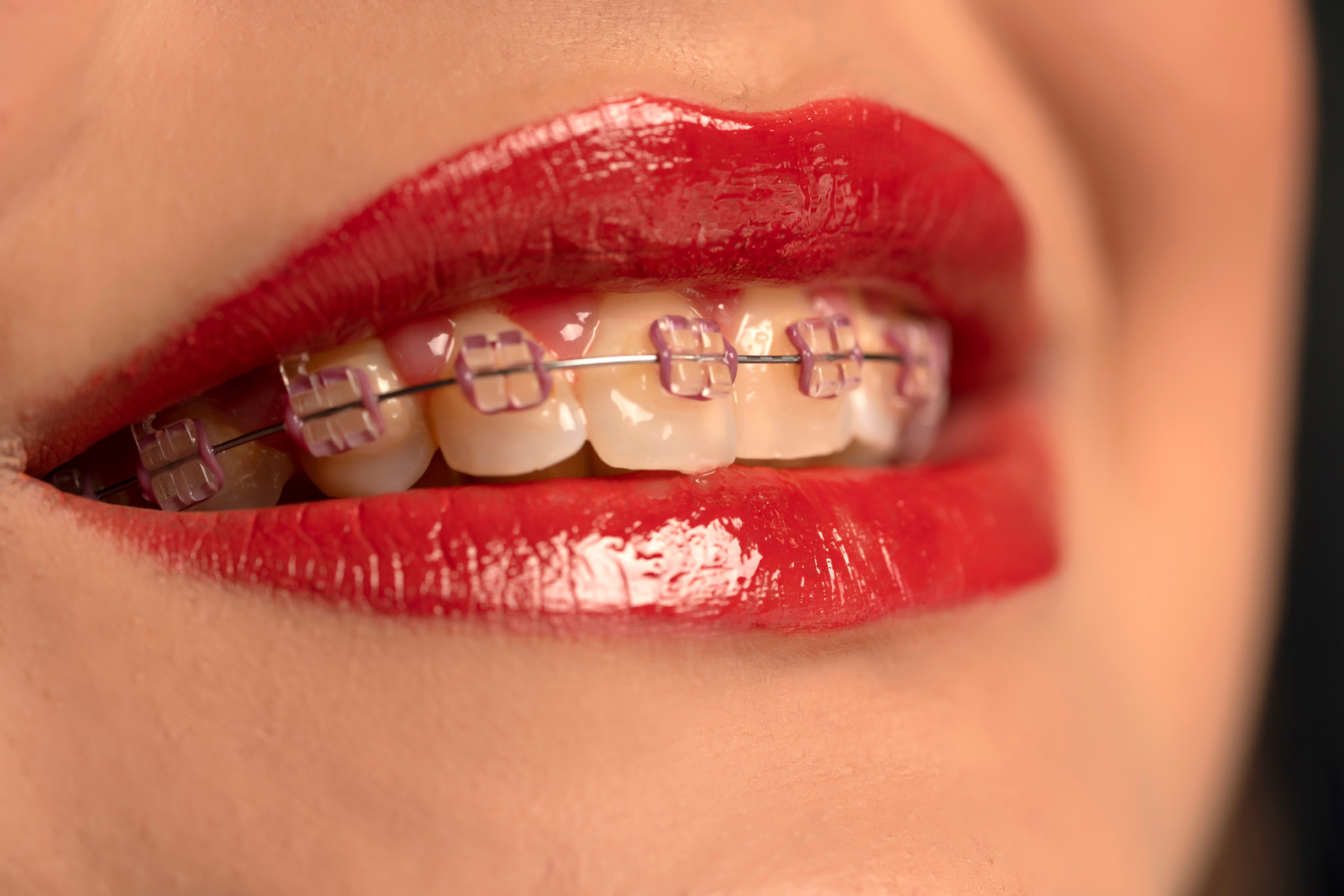 female smiling mouth with braces