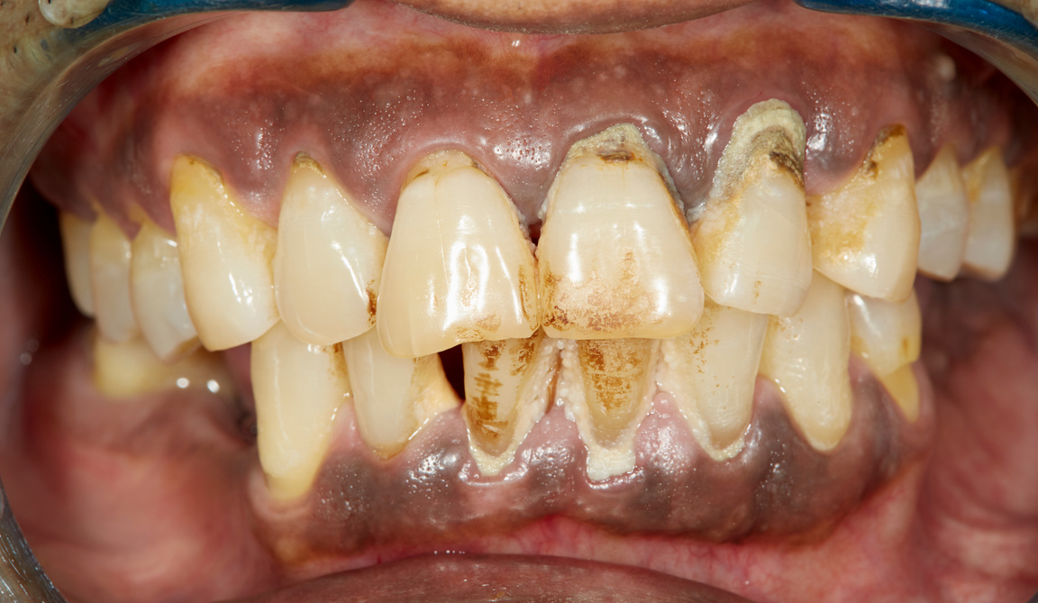 periodontitis