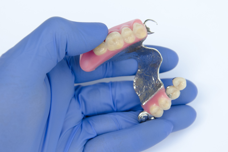 removable clasp prosthesis on the upper jaw