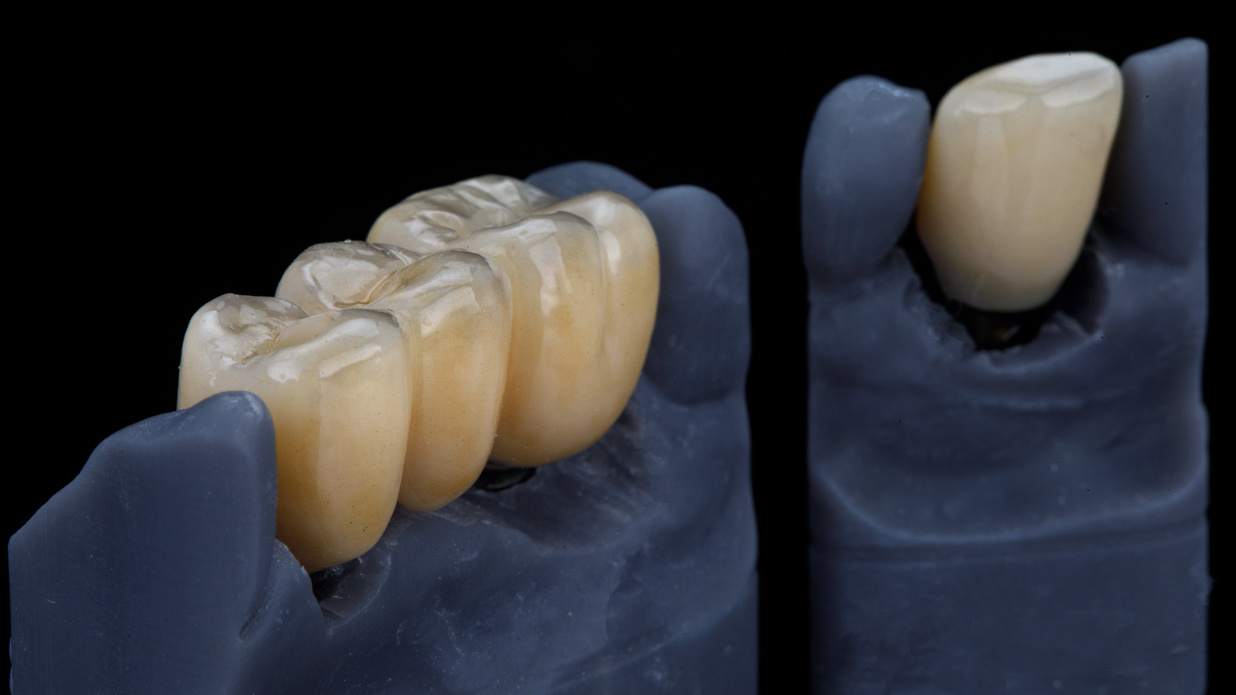 milled zirconium dental crowns on models, composition on a b